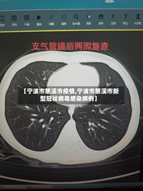 【宁波市慈溪市疫情,宁波市慈溪市新型冠状病毒感染病例】-第1张图片